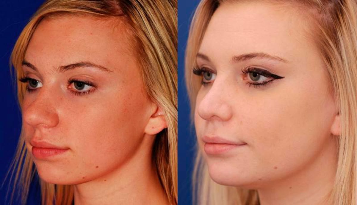 Rhinoplasty Before & After Gallery - Patient 603785 - Image 2