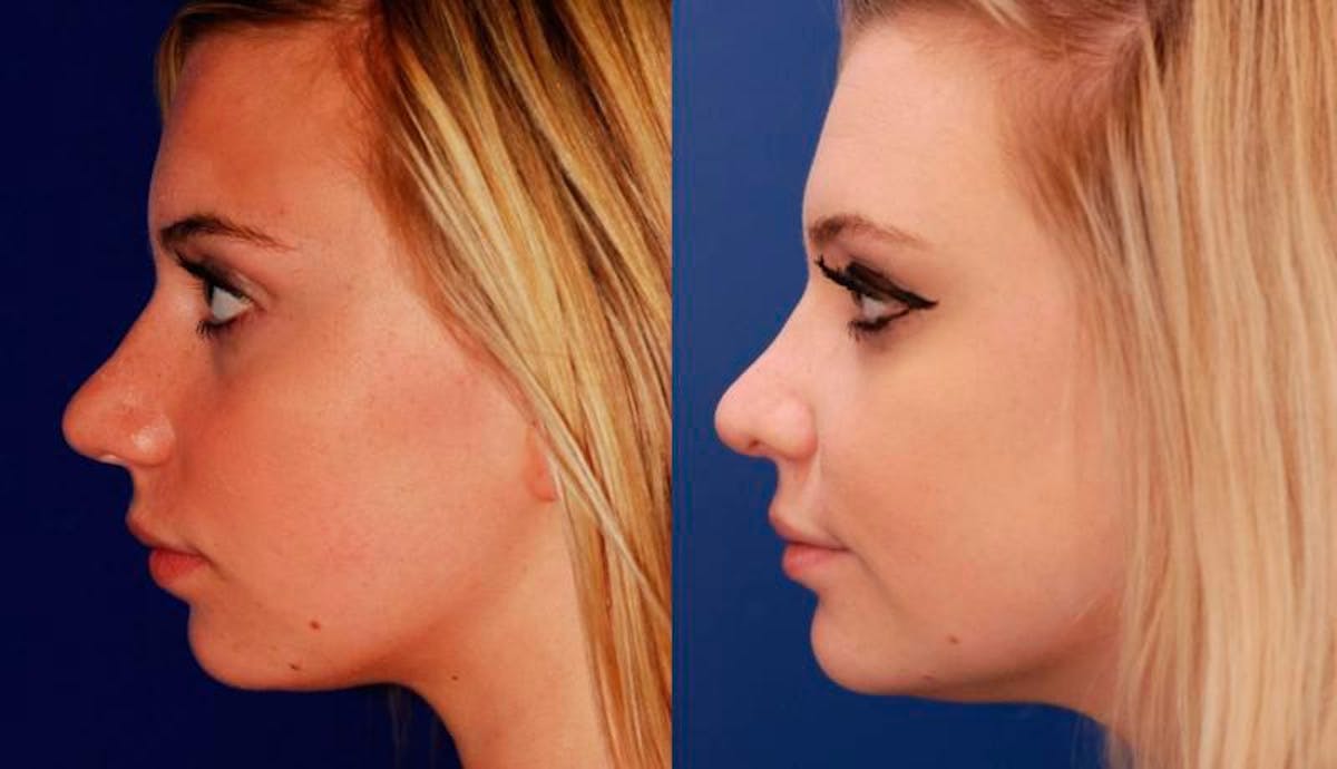 Rhinoplasty Before & After Gallery - Patient 603785 - Image 3