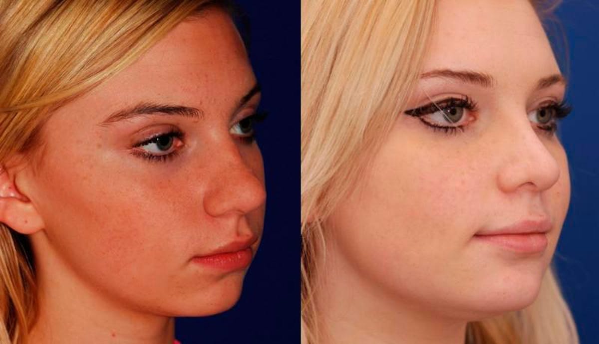 Rhinoplasty Before & After Gallery - Patient 603785 - Image 4