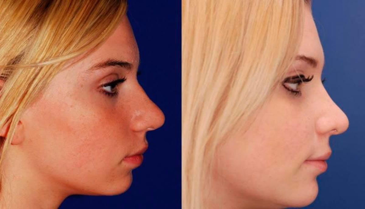 Rhinoplasty Before & After Gallery - Patient 603785 - Image 5
