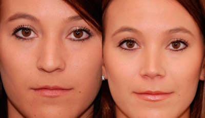 Rhinoplasty Before & After Gallery - Patient 147562 - Image 1