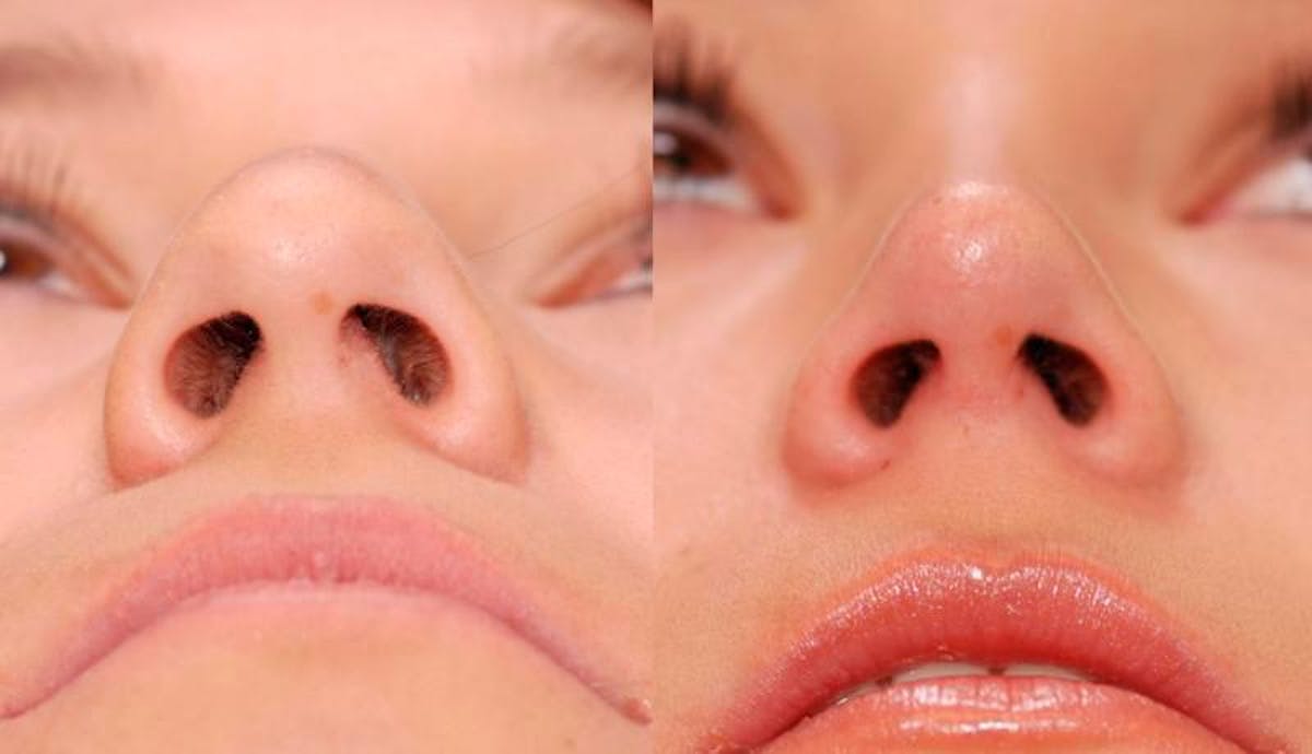 Rhinoplasty Before & After Gallery - Patient 147562 - Image 2