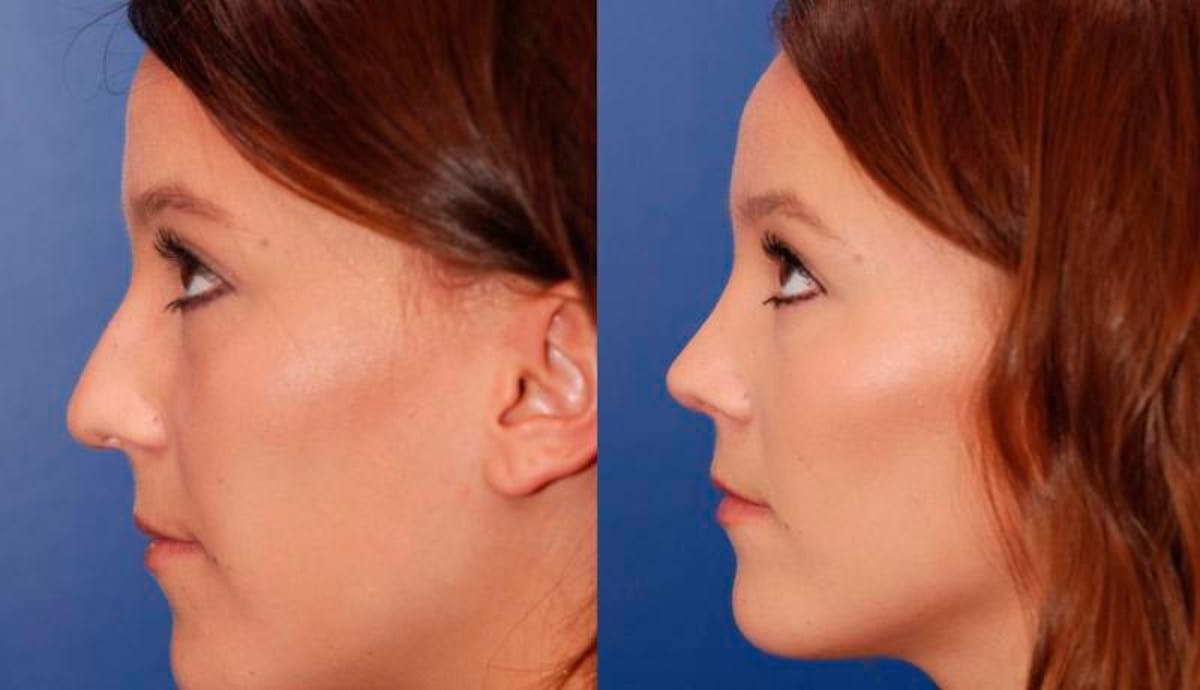 Rhinoplasty Before & After Gallery - Patient 147562 - Image 3