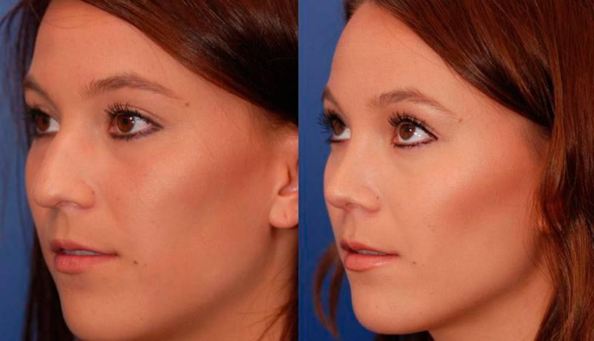 Rhinoplasty Before & After Gallery - Patient 147562 - Image 4