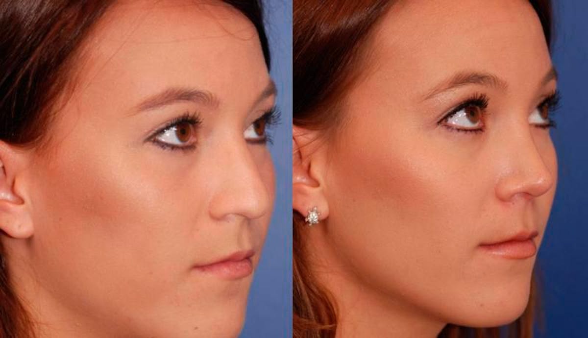 Rhinoplasty Before & After Gallery - Patient 147562 - Image 5
