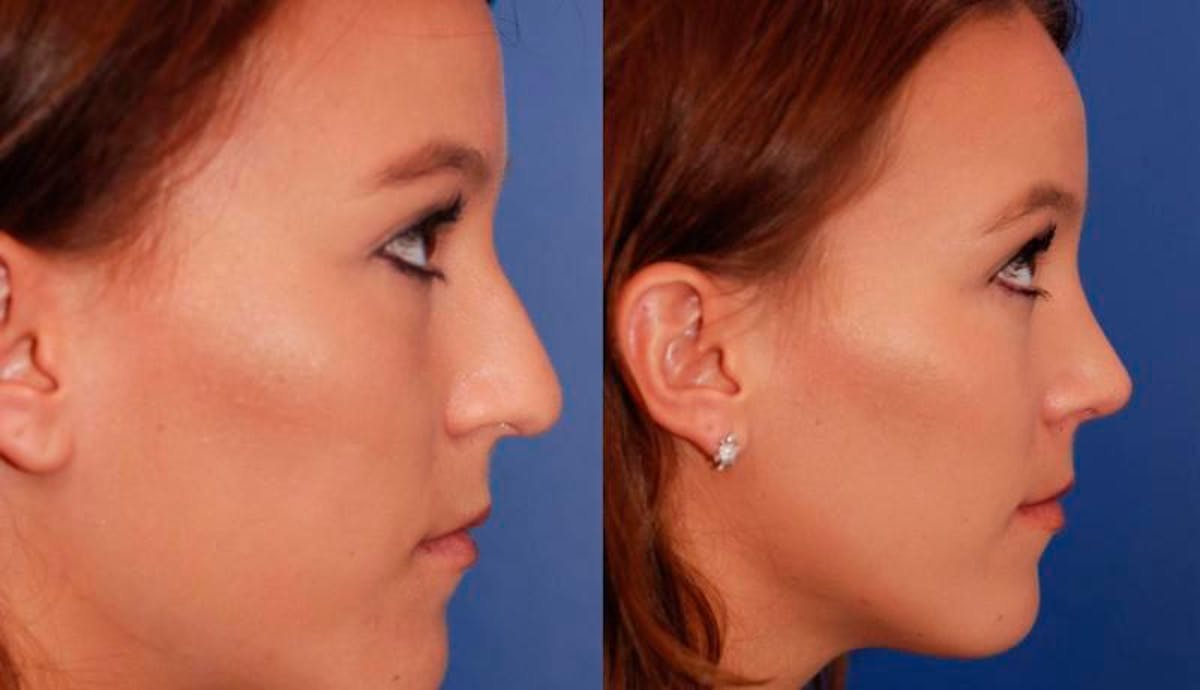 Rhinoplasty Before & After Gallery - Patient 147562 - Image 6