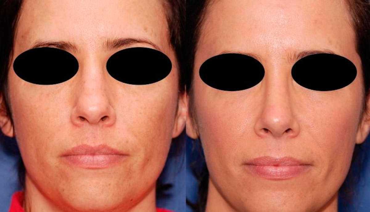 Rhinoplasty Before & After Gallery - Patient 378651 - Image 1