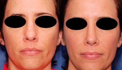 Rhinoplasty Before & After Gallery - Patient 378651 - Image 1