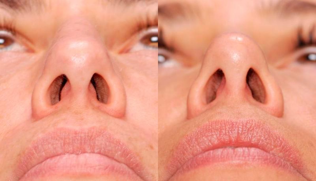Rhinoplasty Before & After Gallery - Patient 378651 - Image 2