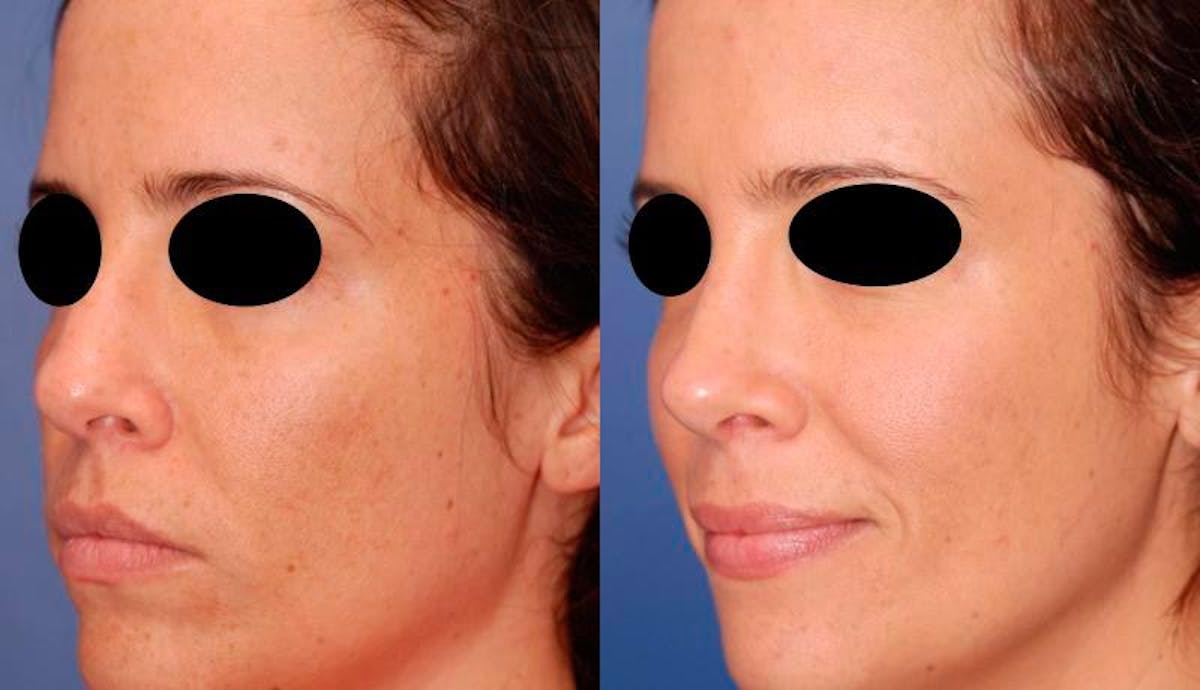 Rhinoplasty Before & After Gallery - Patient 378651 - Image 3