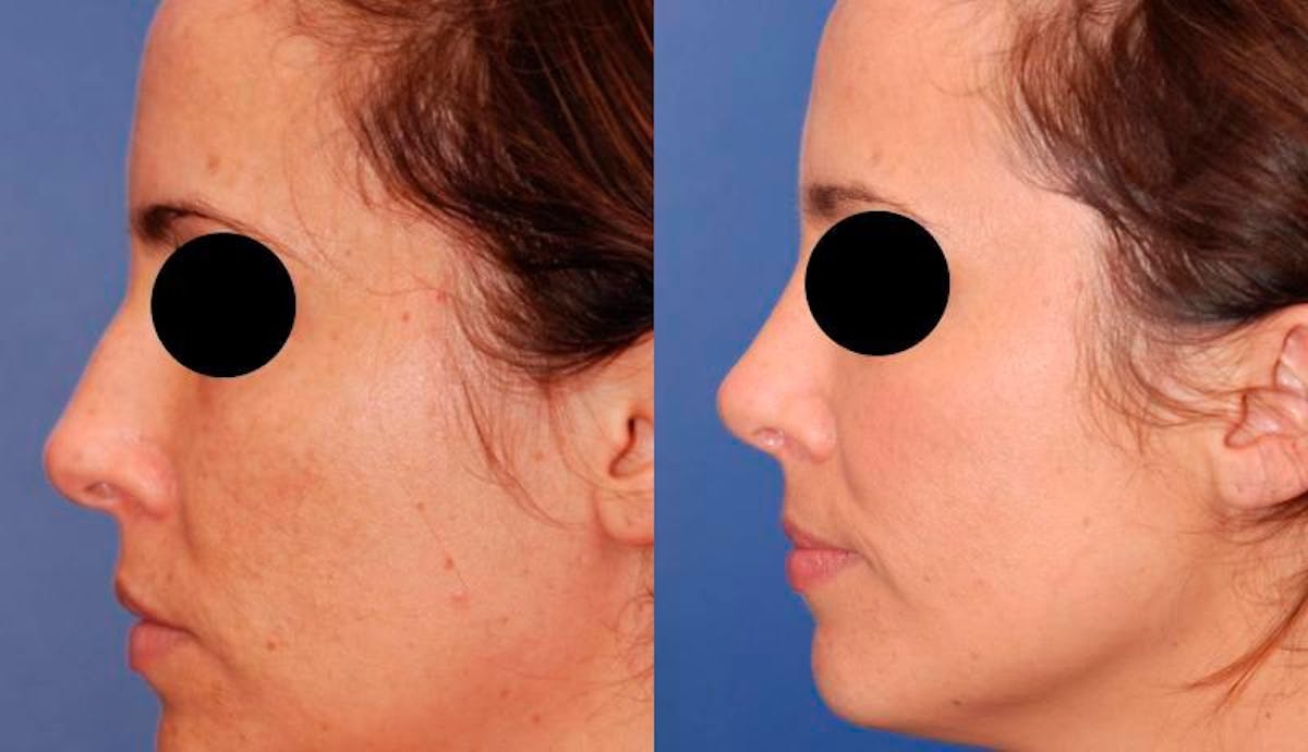 Rhinoplasty Before & After Gallery - Patient 378651 - Image 4