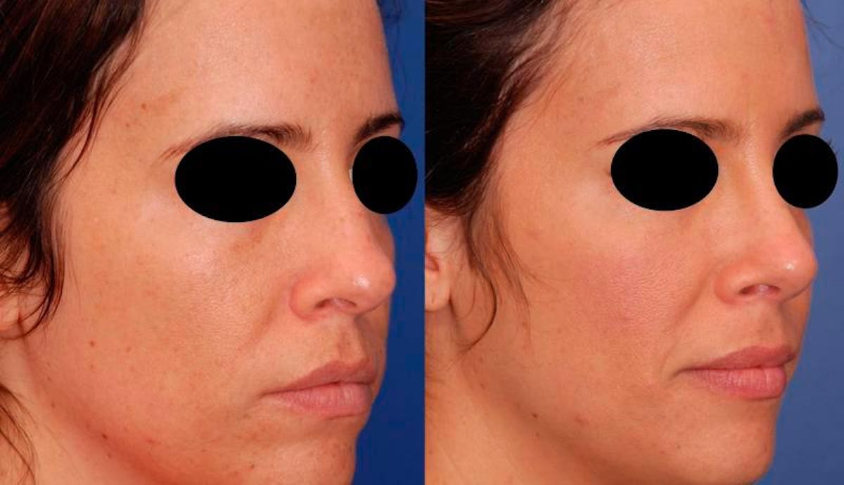 Rhinoplasty Before & After Gallery - Patient 378651 - Image 5