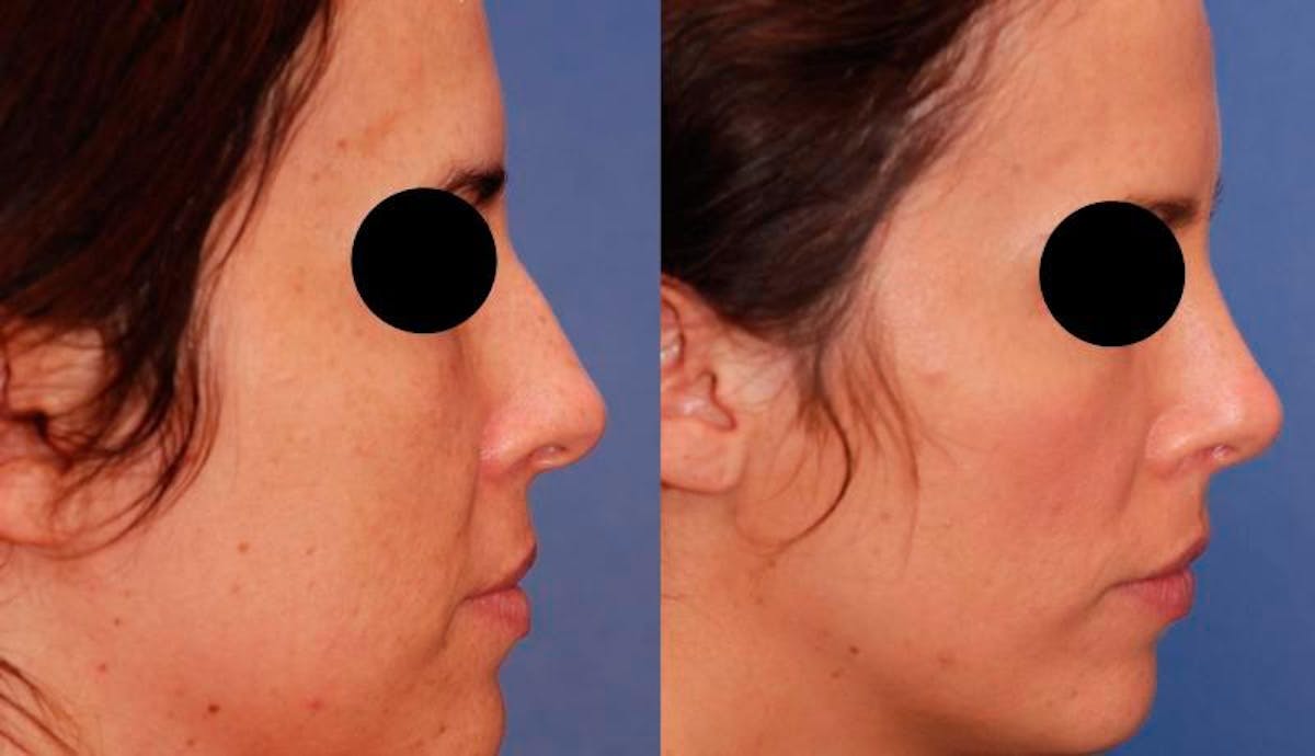 Rhinoplasty Before & After Gallery - Patient 378651 - Image 6