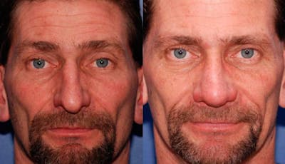 Rhinoplasty Before & After Gallery - Patient 368500 - Image 1