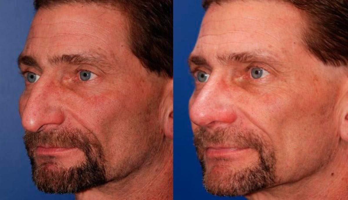 Rhinoplasty Before & After Gallery - Patient 368500 - Image 2