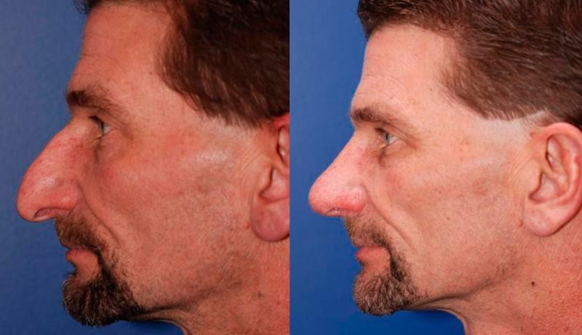 Rhinoplasty Before & After Gallery - Patient 368500 - Image 3