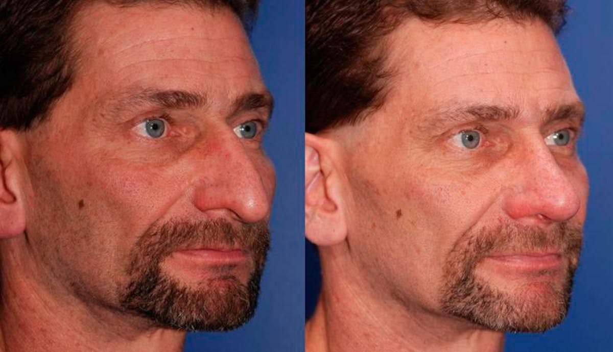 Rhinoplasty Before & After Gallery - Patient 368500 - Image 4