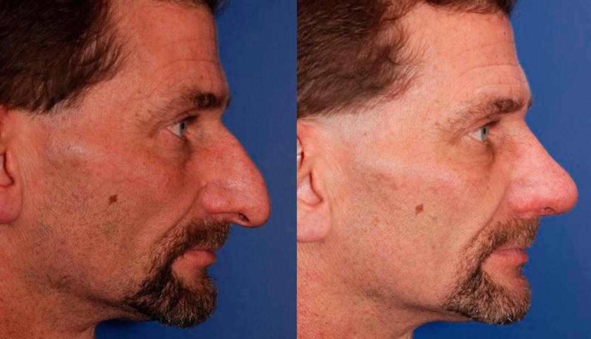 Rhinoplasty Before & After Gallery - Patient 368500 - Image 5