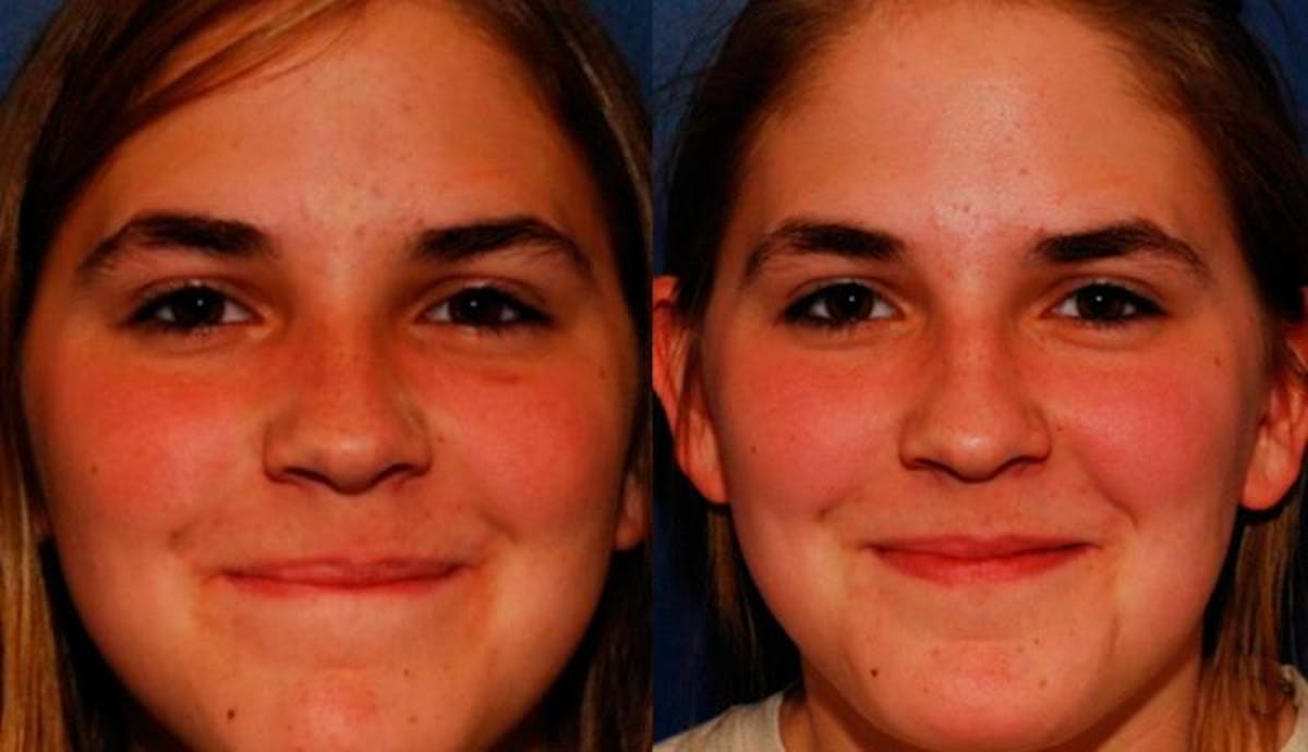 Rhinoplasty Before & After Gallery - Patient 245992 - Image 1
