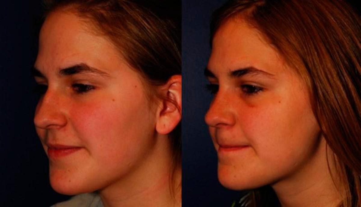 Rhinoplasty Before & After Gallery - Patient 245992 - Image 2