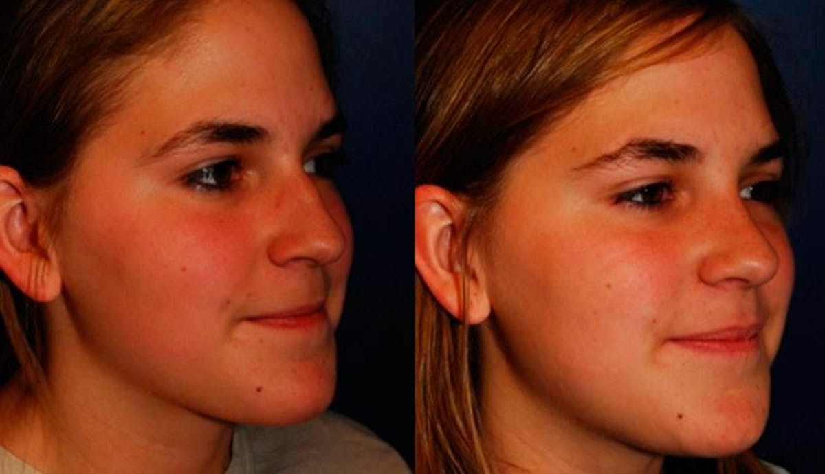 Rhinoplasty Before & After Gallery - Patient 245992 - Image 3