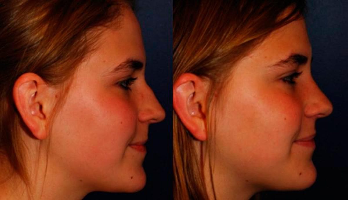 Rhinoplasty Before & After Gallery - Patient 245992 - Image 4