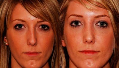 Rhinoplasty Before & After Gallery - Patient 167191 - Image 1