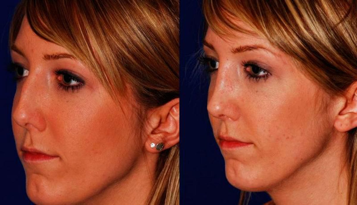 Rhinoplasty Before & After Gallery - Patient 167191 - Image 2
