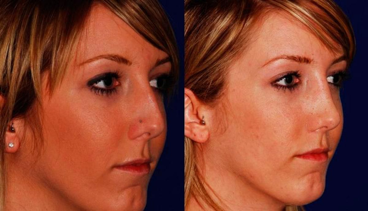 Rhinoplasty Before & After Gallery - Patient 167191 - Image 4