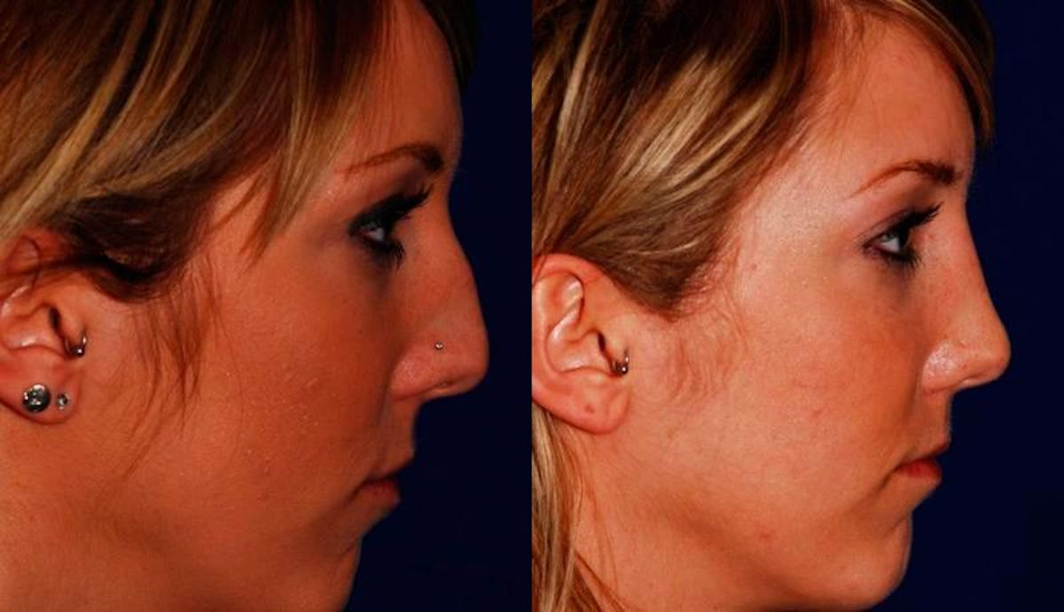 Rhinoplasty Before & After Gallery - Patient 167191 - Image 5