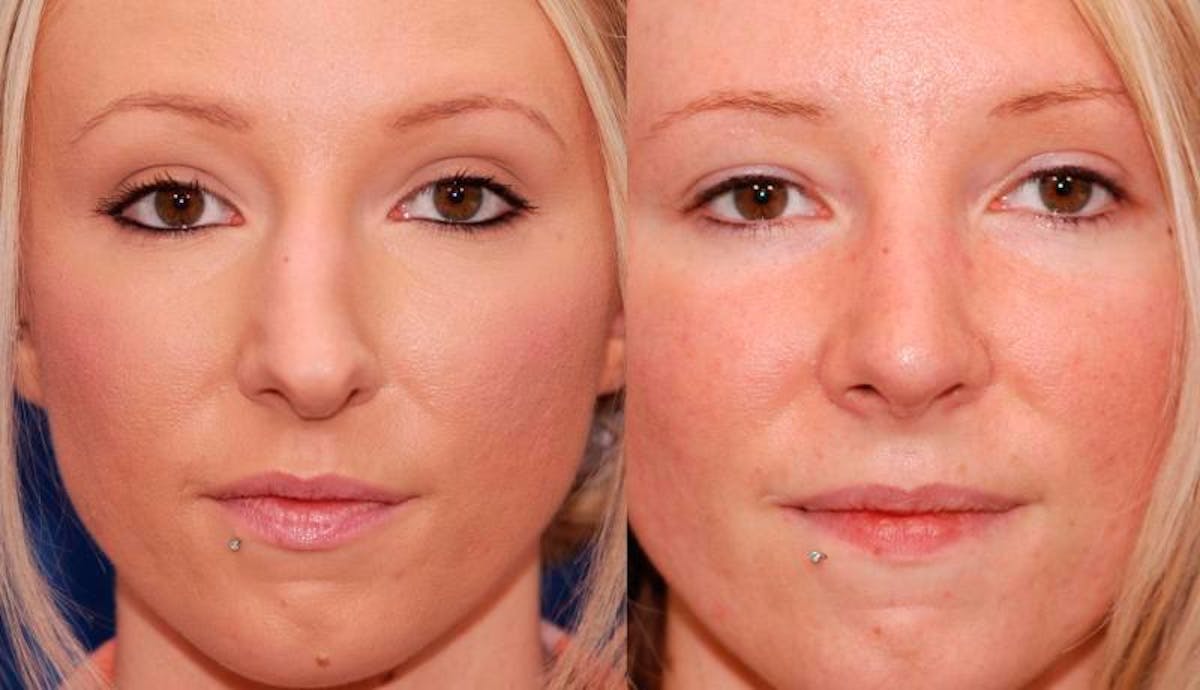 Rhinoplasty Before & After Gallery - Patient 941665 - Image 1