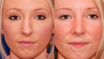Rhinoplasty Before & After Gallery - Patient 941665 - Image 1