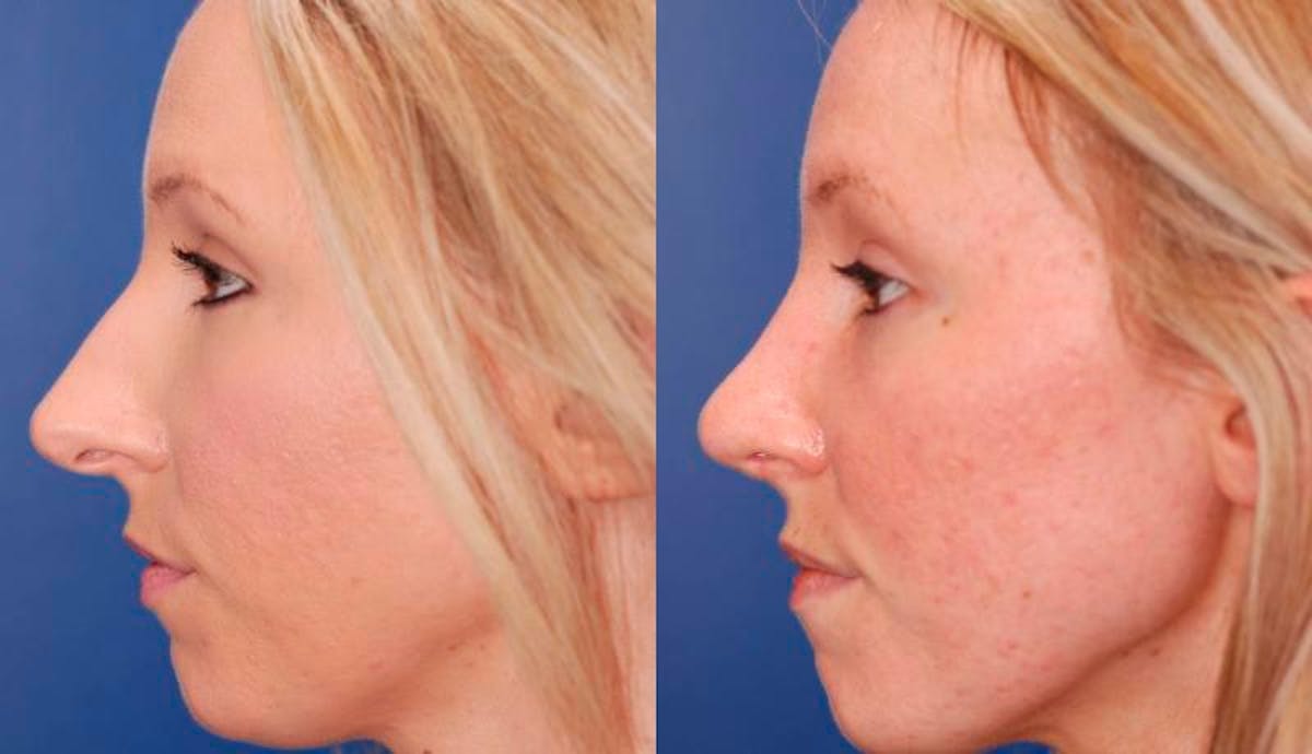 Rhinoplasty Before & After Gallery - Patient 941665 - Image 2