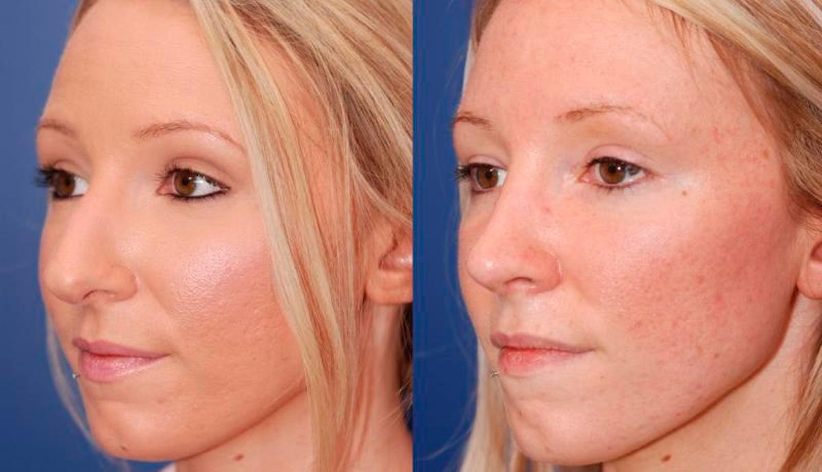 Rhinoplasty Before & After Gallery - Patient 941665 - Image 3