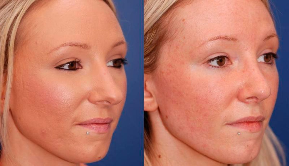 Rhinoplasty Before & After Gallery - Patient 941665 - Image 4