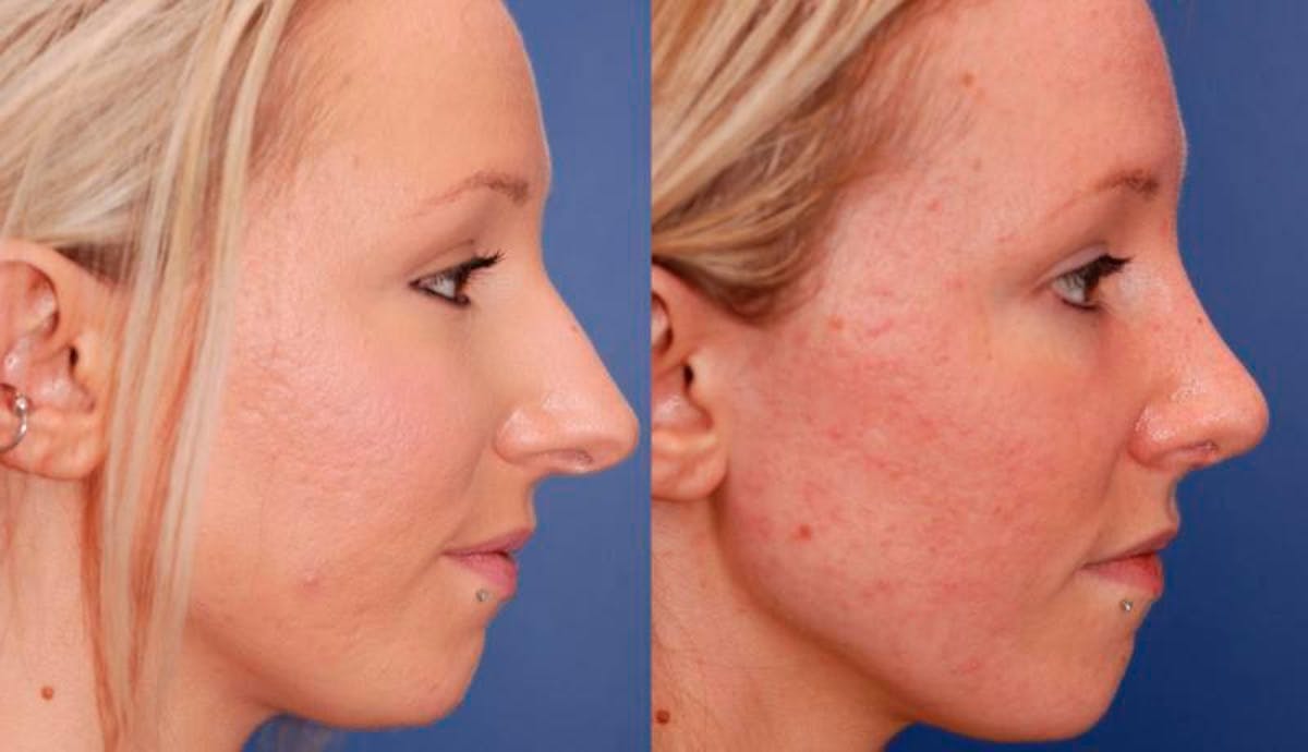 Rhinoplasty Before & After Gallery - Patient 941665 - Image 5