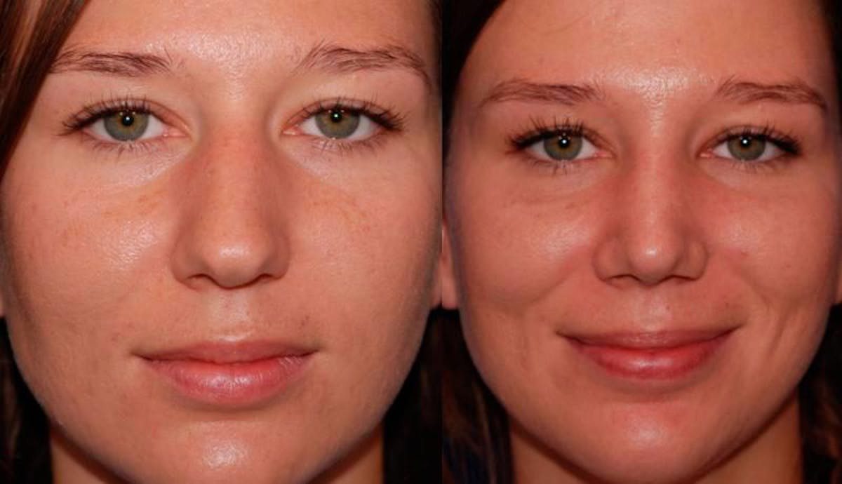 Rhinoplasty Before & After Gallery - Patient 950804 - Image 1