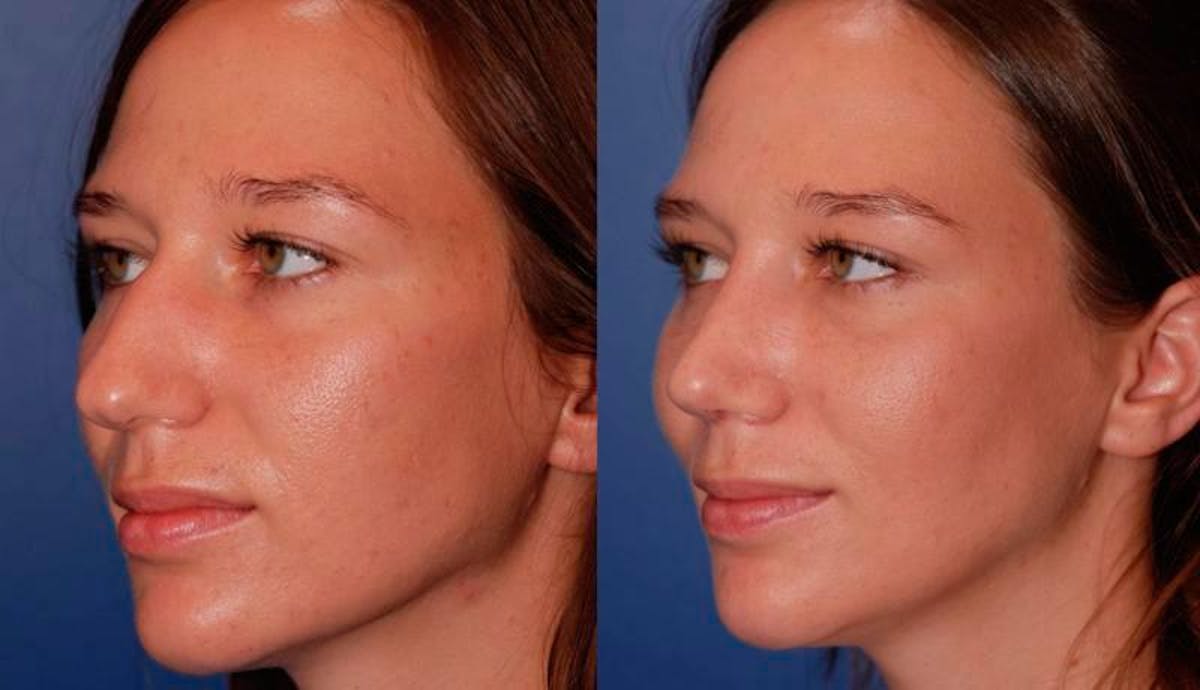 Rhinoplasty Before & After Gallery - Patient 950804 - Image 2