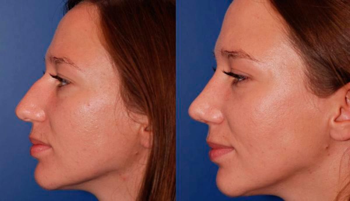 Rhinoplasty Before & After Gallery - Patient 950804 - Image 3