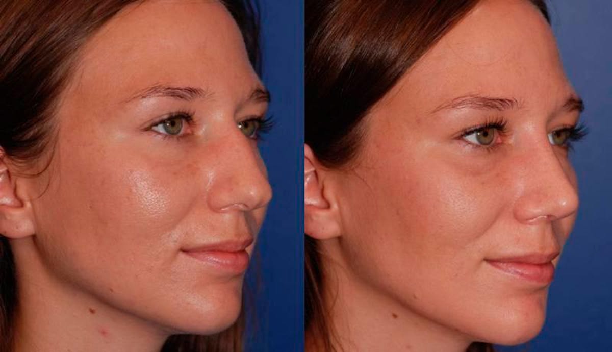Rhinoplasty Before & After Gallery - Patient 950804 - Image 4