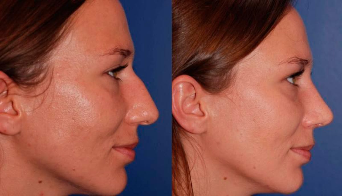 Rhinoplasty Before & After Gallery - Patient 950804 - Image 5