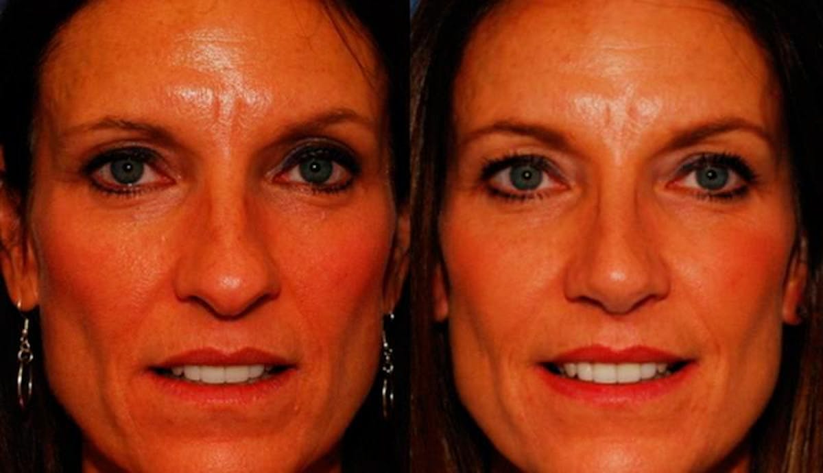 Rhinoplasty Before & After Gallery - Patient 950416 - Image 1