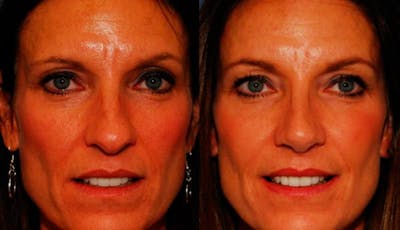 Rhinoplasty Before & After Gallery - Patient 950416 - Image 1