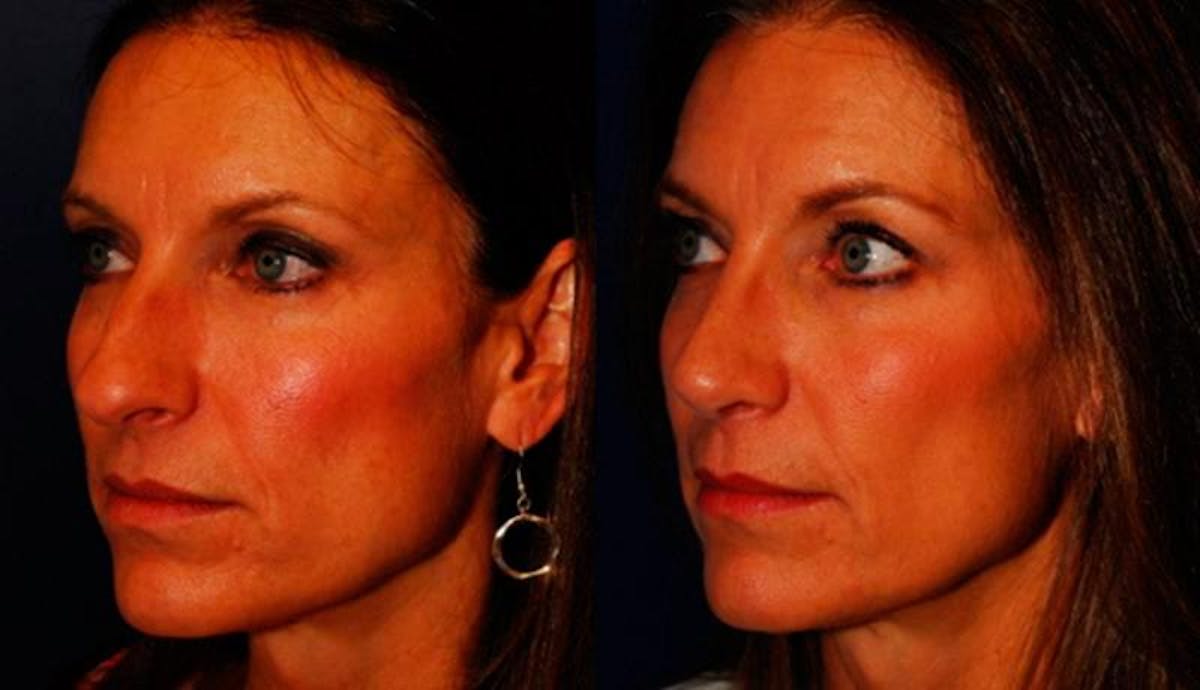Rhinoplasty Before & After Gallery - Patient 950416 - Image 2