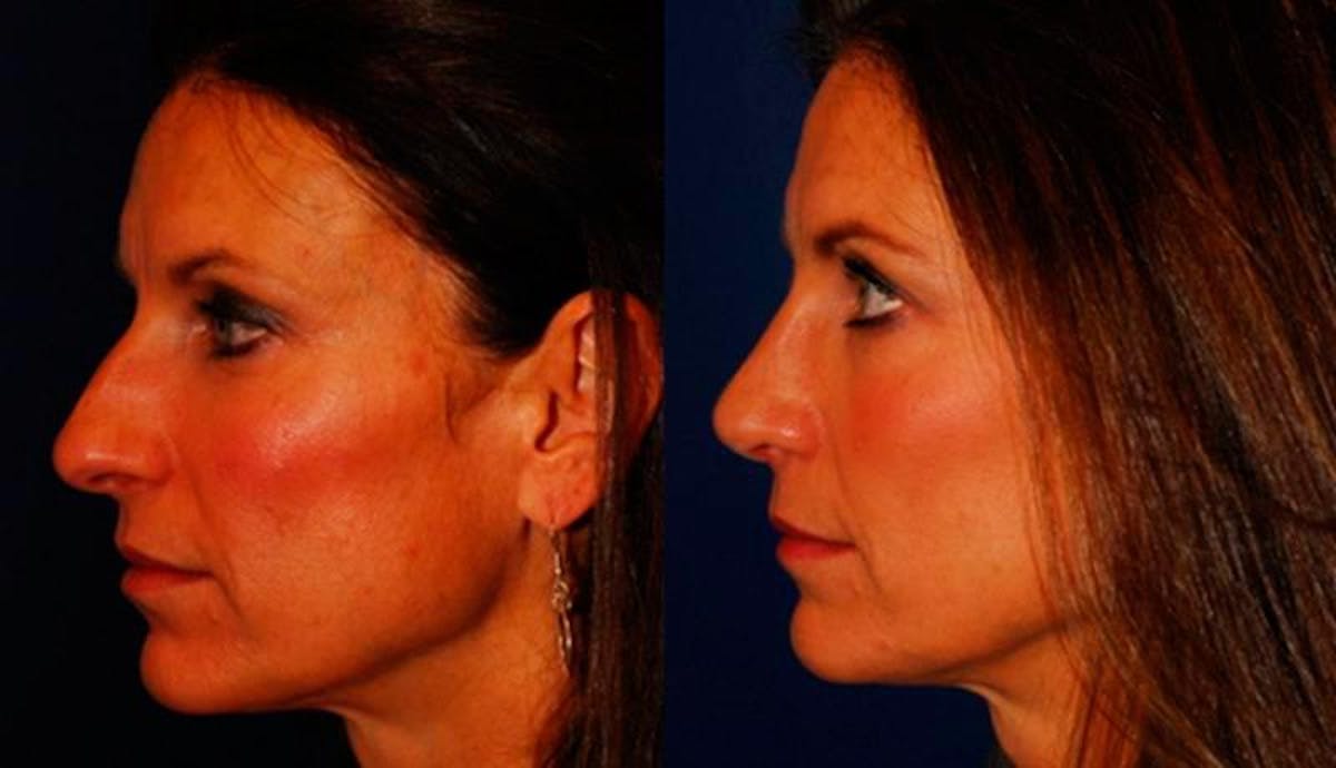 Rhinoplasty Before & After Gallery - Patient 950416 - Image 3