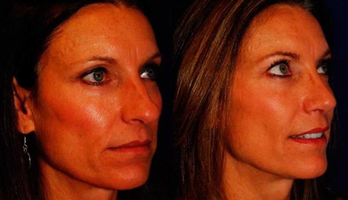 Rhinoplasty Before & After Gallery - Patient 950416 - Image 4