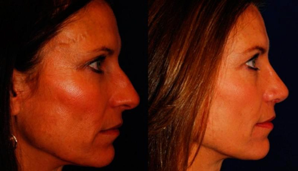 Rhinoplasty Before & After Gallery - Patient 950416 - Image 5
