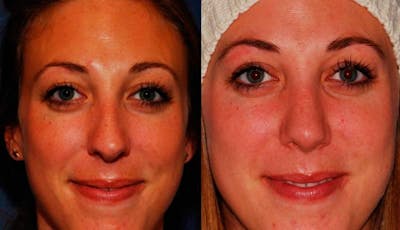 Rhinoplasty Before & After Gallery - Patient 329885 - Image 1