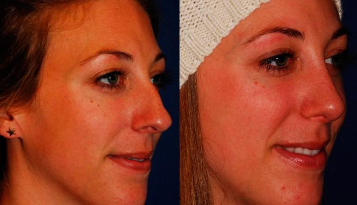 Rhinoplasty Before & After Gallery - Patient 329885 - Image 2