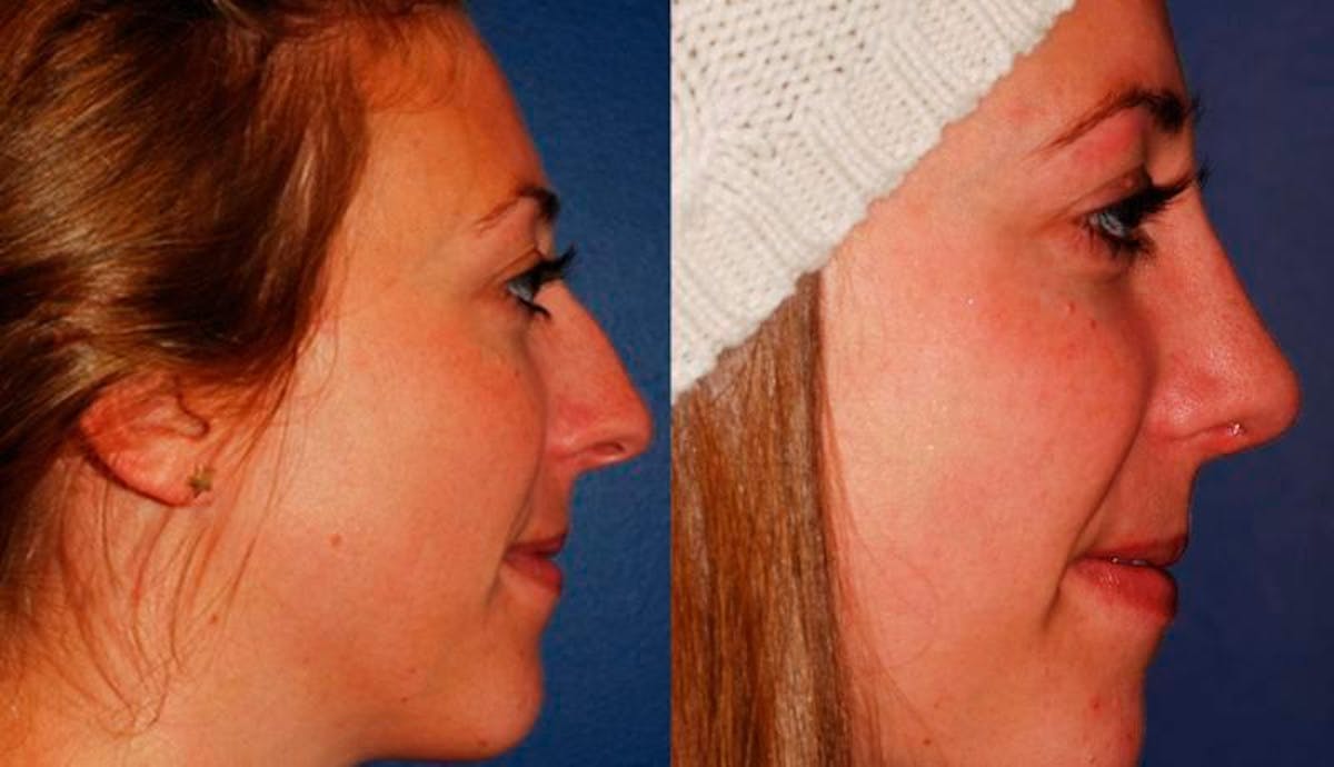 Rhinoplasty Before & After Gallery - Patient 329885 - Image 3